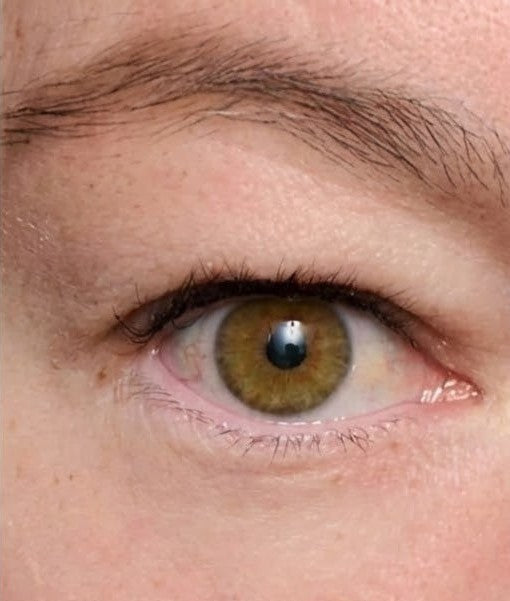 Párpado inferior antes y después del tensor EyeLift, con la bolsa de aspecto más liso